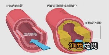 怎么降血脂效果好