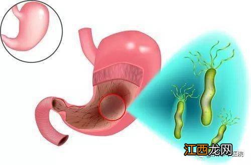 辣椒素能抑制幽门螺旋杆菌生长吗-杀了幽门螺旋杆菌还会被传染吗