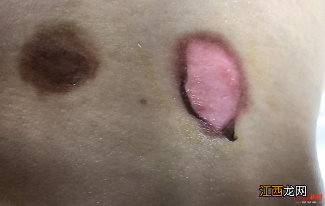 如果非要带孩子去三伏贴,请把这颗后悔药也带上