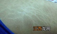 怎么可以消除妊娠纹?淡化消除妊娠纹方法有哪些？