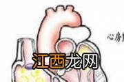 心肌缺血怎么医治 心肌缺血的危害