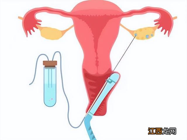 三次试管婴儿全部失败，希望我的经历给所有人敲响警钟