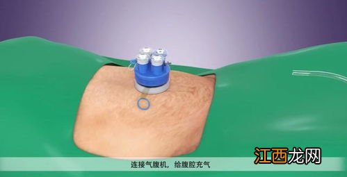 有胆结石吃什么好窍门