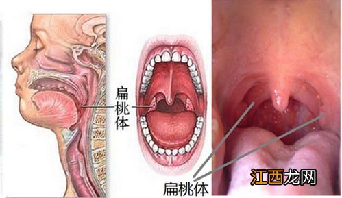 炎喉咙吃什么好呢