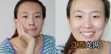 医院针清祛痘多少钱一次-医院针清痘痘挂什么科