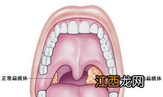 扁桃体发炎引起发烧怎么办？可以这样治疗