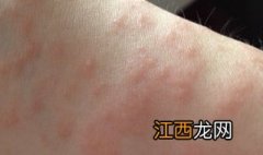 孕妇得了湿疹怎么办？以下方法助你解决问题