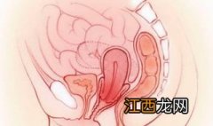 子宫移位怎么办？主要有两种治疗方式