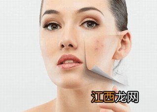 闭合性粉刺应该如何治疗