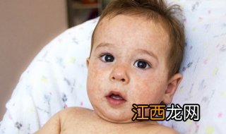 宝宝奶粉过敏怎么办