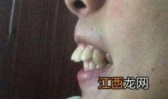 龅牙怎么办