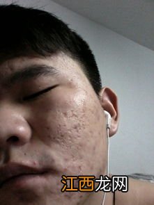 喝黑茶脸上怎么长痘痘了