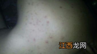 吃什么粥能去除痘痘