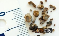 肾结石忌讳什么食物