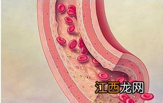 脑血管硬化适合吃什么