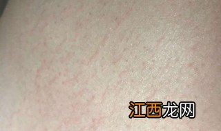 激光去妊娠纹多少钱一次 妊辰纹会自己消失吗