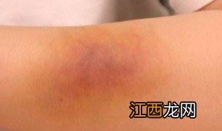 鸡蛋敷淤青正确做法 有用吗