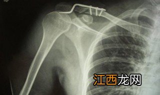 锁骨中断骨折评残标准是什么 锁骨中断骨折评残标准